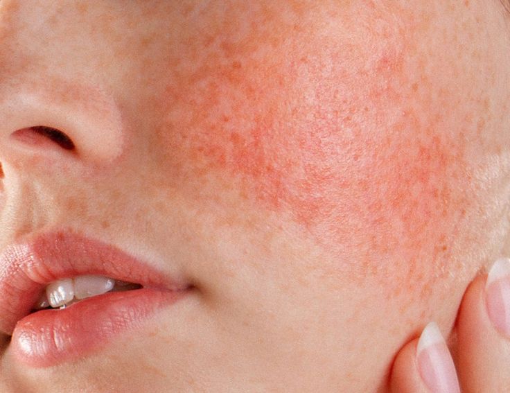 Da Dễ Kích Ứng, Đỏ Rát Dù Dùng Sản Phẩm Dịu Nhẹ