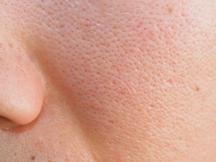 LỖ CHÂN LÔNG TO – MỤN ẨN – DA BÓNG NHỜN: VẤN ĐỀ KHÔNG CỦA RIÊNG AI